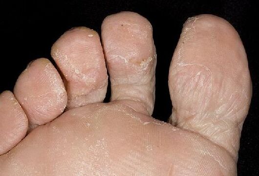 Candidiasis del pie