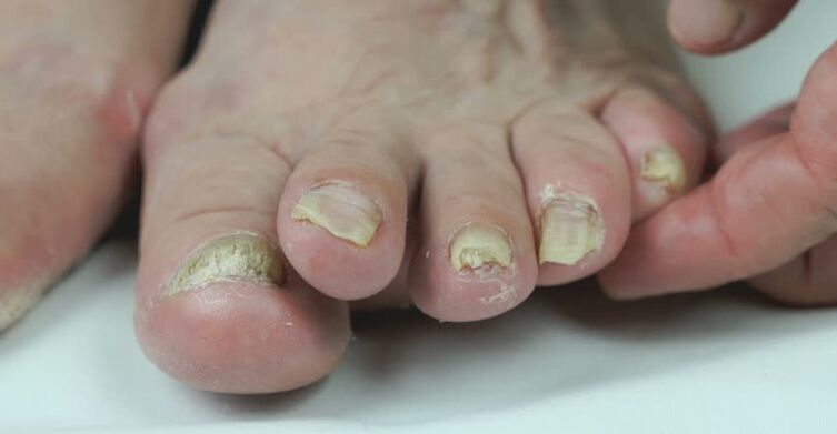 Onicomicosis