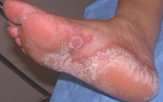 Dermatomicosis aguda del pie