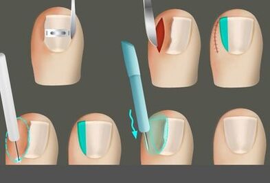Eliminar la uña en presencia de un hongo en las piernas