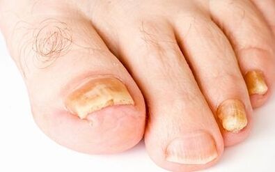 Síntomas fotográficos del hongo de las uñas