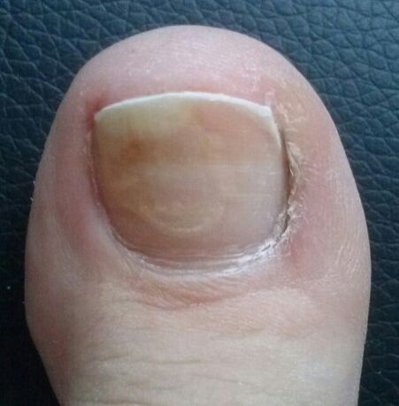 El hongo de la uña en el pulgar