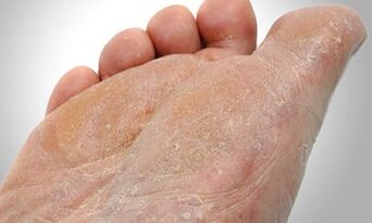 Rutas de transmisión de hongos del pie