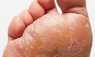 Signos y síntomas de hongos en las piernas