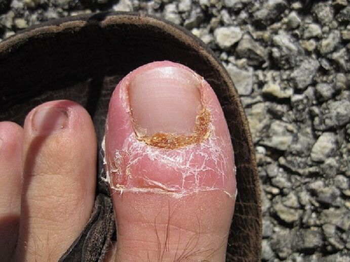 daño a las uñas y la piel de los dedos de los pies debido a una infección por hongos