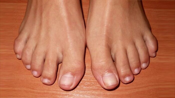 uñas de los pies sanas sin infección por hongos